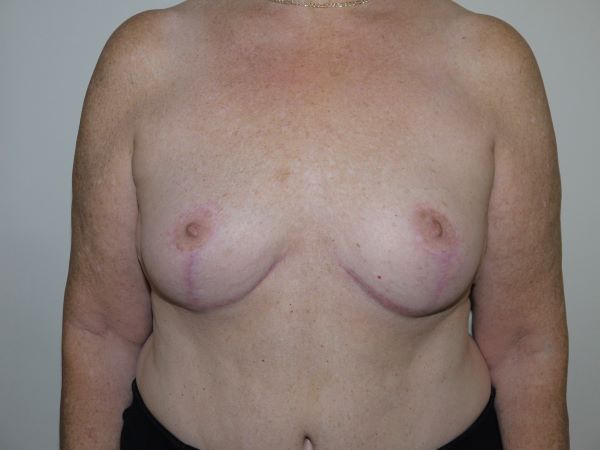 After Image: Breast Implant Removal with Lift - front