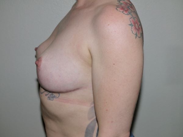 After Image: Breast Implant Removal with Lift - left-side