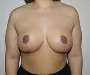 After Image: Breast Reduction