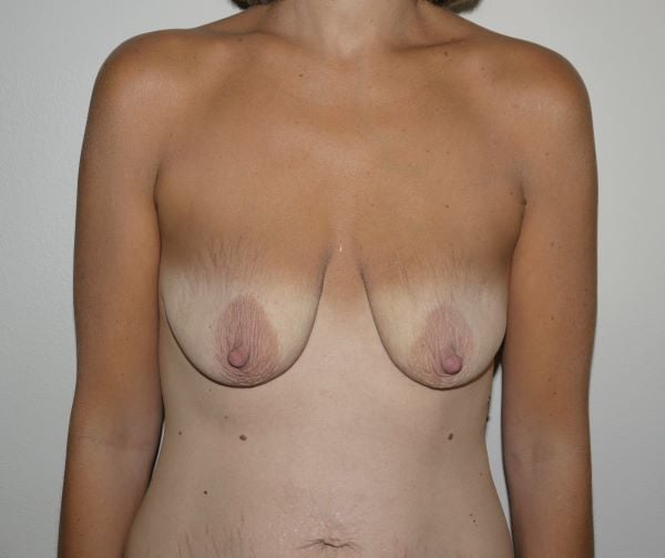 Before Image: Breast Lift with Augmentation - front