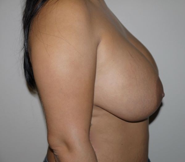 Before Image: Breast Implant Removal with Lift - right-side
