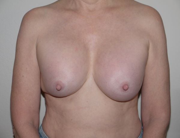 Before Image: Breast Implant Revision - front