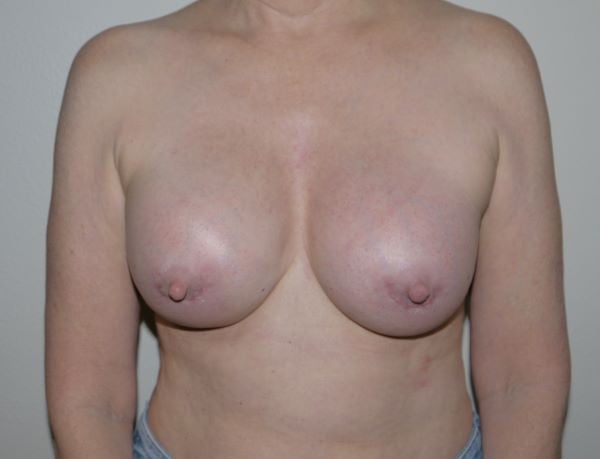 After Image: Breast Implant Revision - front