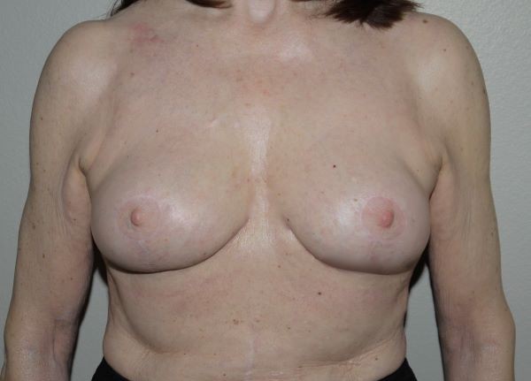 After Image: Breast Implant Removal with Lift - front