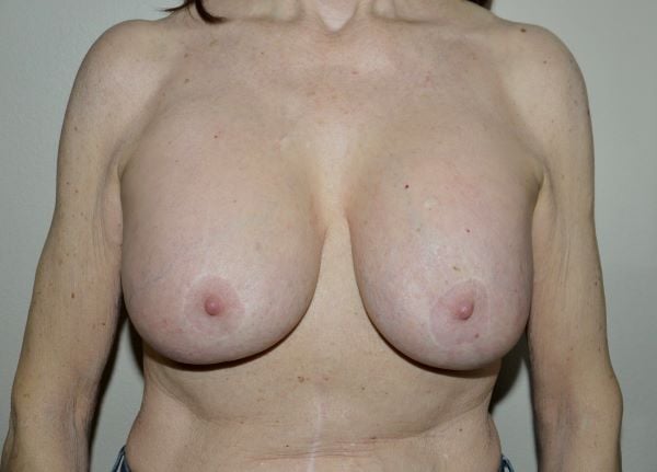 Before Image: Breast Implant Removal with Lift - front