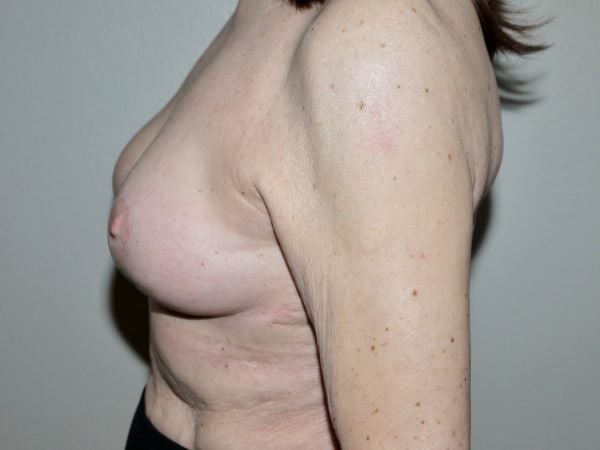 After Image: Breast Implant Removal with Lift - left-side