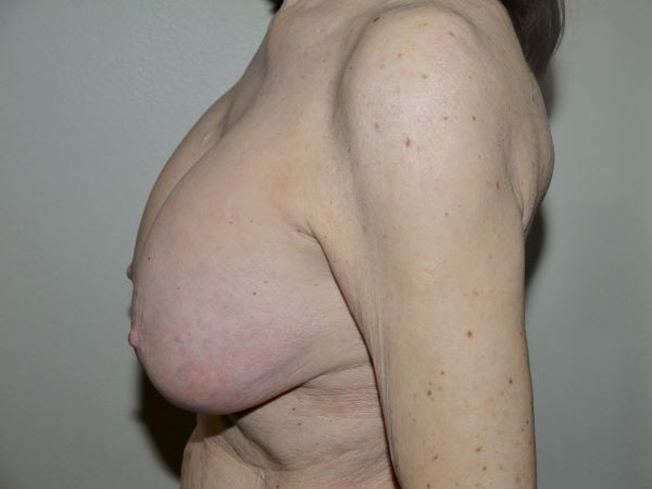 Before Image: Breast Implant Removal with Lift - left-side