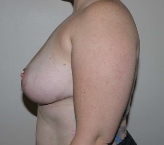 After Image: Breast Implant Removal with Lift - left-side