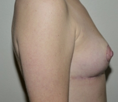 After Image: Breast Implant Removal with Lift - right-side
