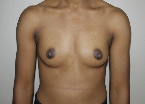 Before Image: Breast Augmentation - front