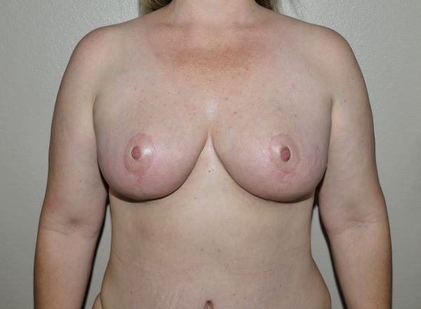 After Image: Breast Reduction - front