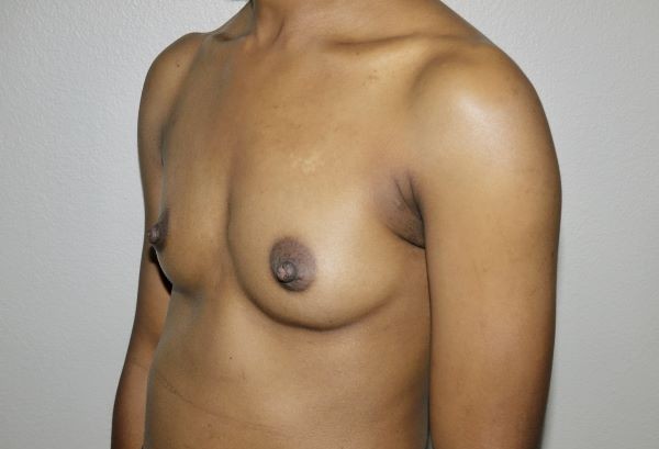 Before Image: Breast Augmentation - left-front-oblique
