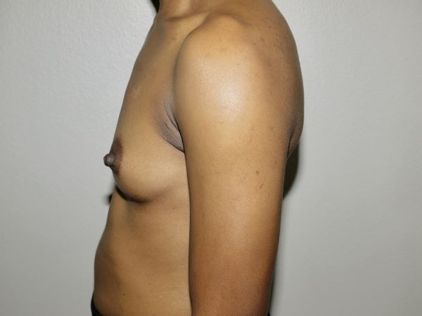 Before Image: Breast Augmentation - left-side