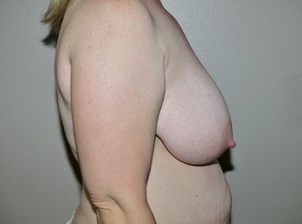 Before Image: Breast Reduction - right-side