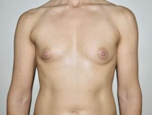 Breast Augmentation