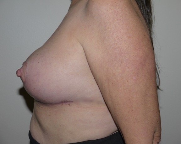 After Image: Breast Implant Removal with Lift - left-side