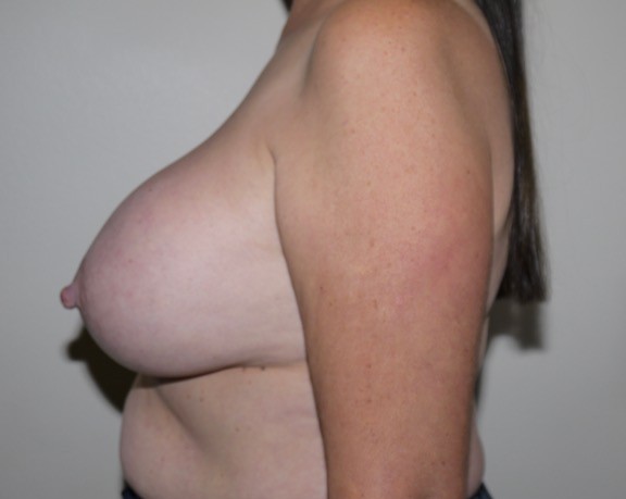 Before Image: Breast Implant Removal with Lift - left-side
