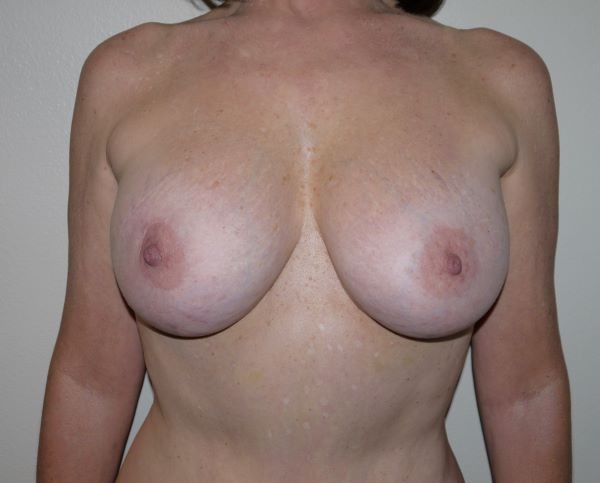 Before Image: Breast Implant Removal with Lift - front