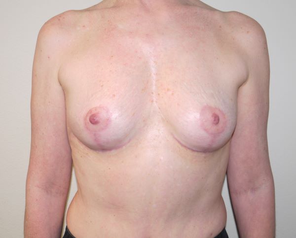 After Image: Breast Implant Removal with Lift - front