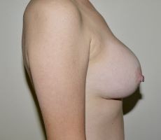 Before Image: Breast Implant Removal with Lift - right-side