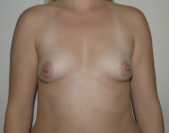 Before Image: Breast Augmentation - front