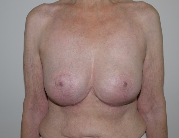 After Image: Breast Implant Removal with Lift - front