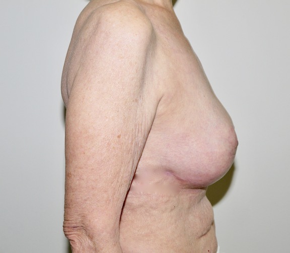 After Image: Breast Implant Removal with Lift - right-side