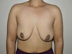 Breast Lift with Augmentation