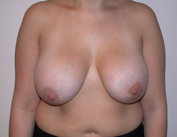 Before Image: Breast Implant Removal with Lift - front