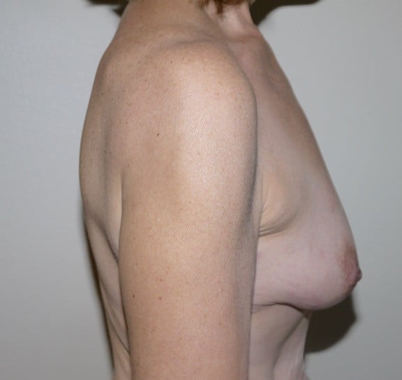 Before Image: Breast Lift with Augmentation - right-side