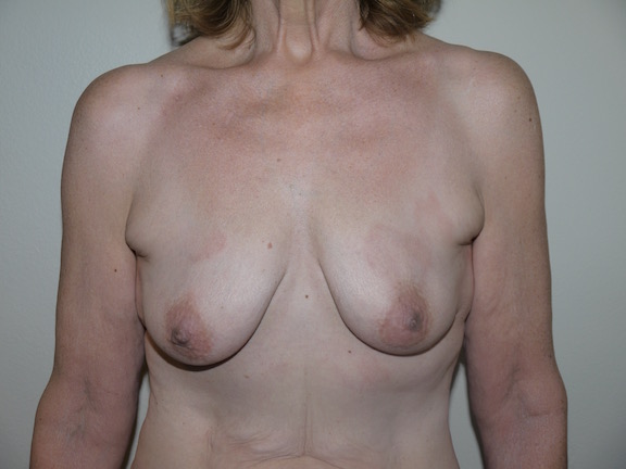 Before Image: Breast Lift with Augmentation - front