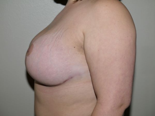 After Image: Breast Lift with Augmentation - left-side