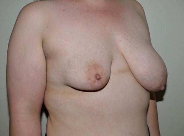 Before Image: Breast Lift with Augmentation - right-front-oblique