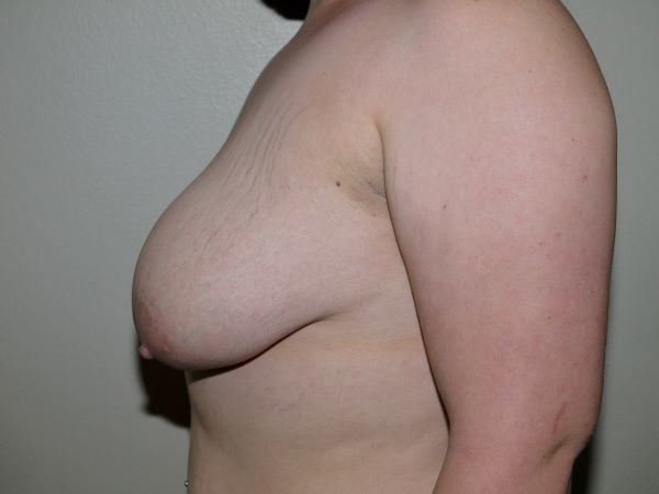 Before Image: Breast Lift with Augmentation - left-side