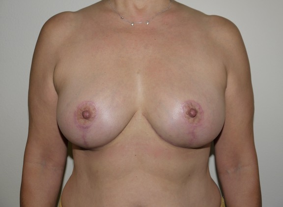 After Image: Breast Implant Removal with Lift - front