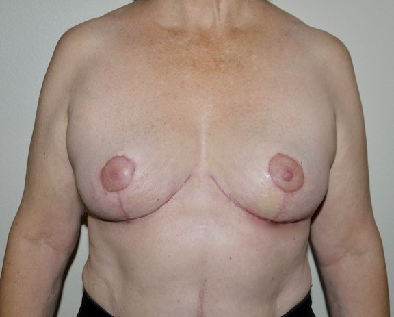 After Image: Breast Implant Removal with Lift - front