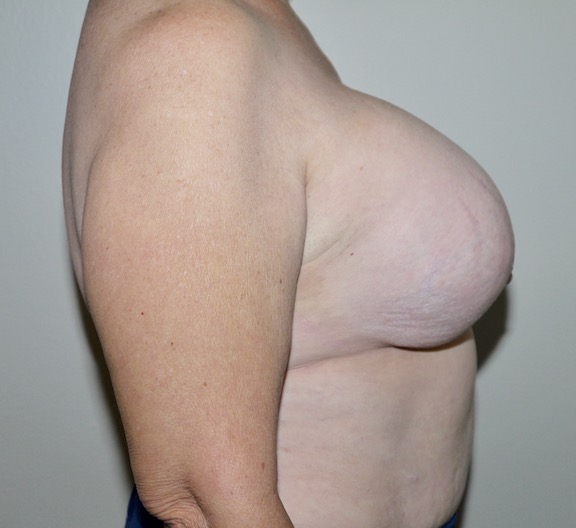 Before Image: Breast Implant Removal with Lift - right-side