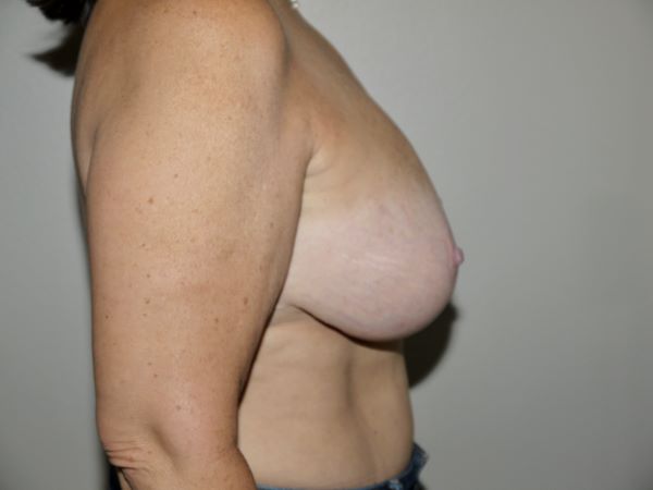 Before Image: Breast Implant Removal with Lift - right-side