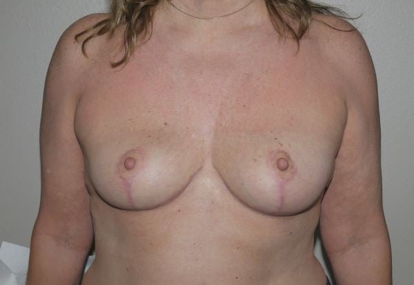After Image: Breast Implant Removal with Lift - front