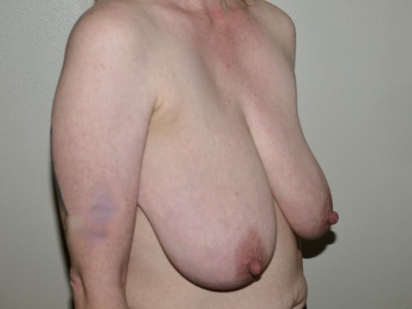 Before Image: Breast Reduction - right-front-oblique