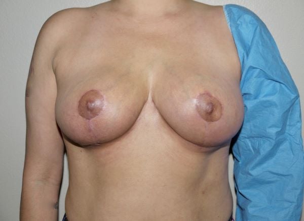 After Image: Breast Implant Removal with Lift - front