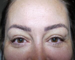 Eyelid Surgery