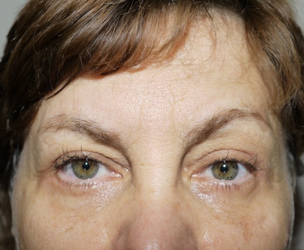 After Image: Eyelid Surgery - front