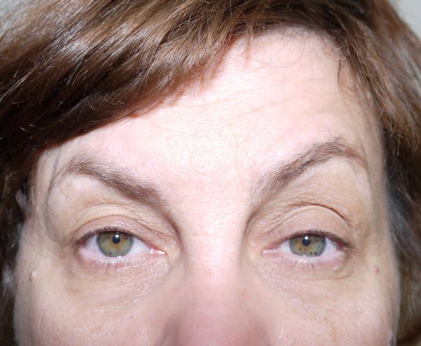 Before Image: Eyelid Surgery - front
