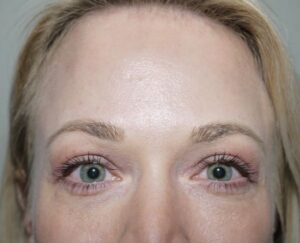 After Image: Eyelid Surgery