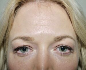 Before Image: Eyelid Surgery