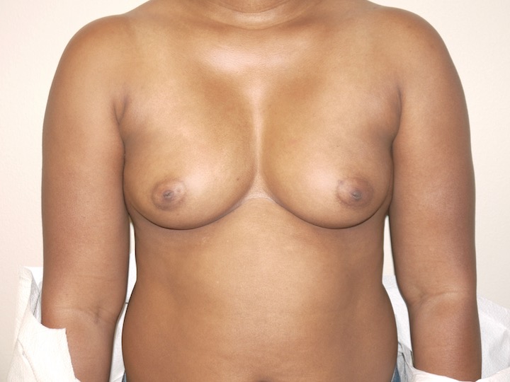 Before Image: Breast Augmentation - front