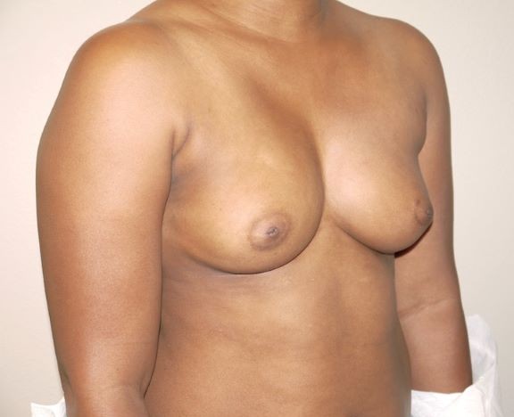 Before Image: Breast Augmentation - right-front-oblique