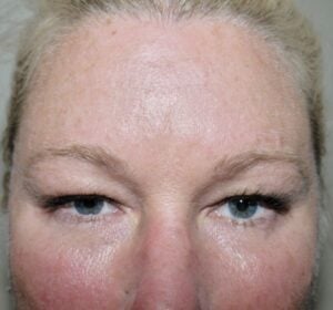 Forehead Lift Desert Hills Plastic Surgery Center