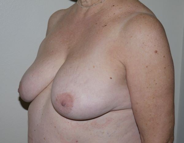 Before Image: Breast Lift - left-front-oblique